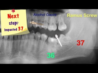 Chris Chang Ortho. Simplified Mechanics for Aligners in Treating Complex Cases Part6