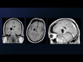 Supracerebellar Transtentorial Approach for Resection of a Basal Ganglia_Thalami