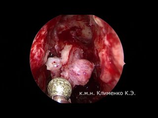 Эндоскопическая расширенная операция на лобных пазухах (Draf 3)