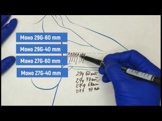 Схема постановки мезонитей Seocore на область рук.