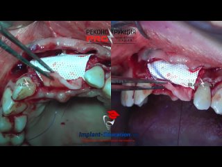 Направленная костная регенерация нерезорбируемой мембраной во фронтальном отделе.mp4
