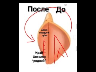 Говоря проще, лабиопластика - это процедура, которая уменьшает длину малых половых губ, меняет их форму.