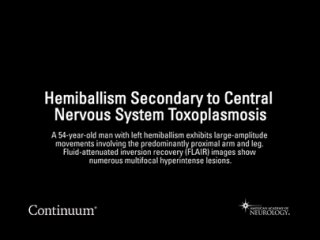 Video shows a 54-year-old man with left hemiballism large-amplitude movements involving the predominantly proximal arm and leg