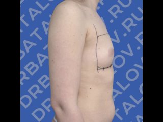 Увеличение груди (маммопластика, год)