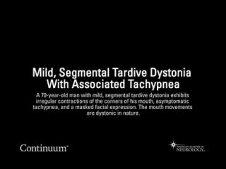 TARDIVE DYSTONIA