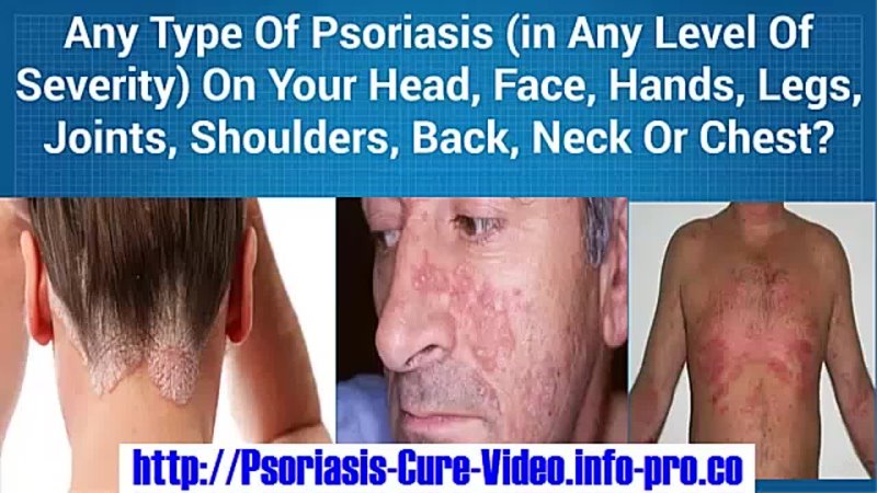 Psoriasis Vulgaris, Psoriasis On The Scalp, Can Psoriasis Be Cured, Vitamin D And