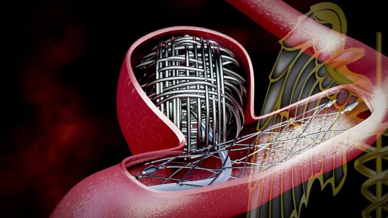 3 D Medical Video ( HD) Cerebral Aneurysm