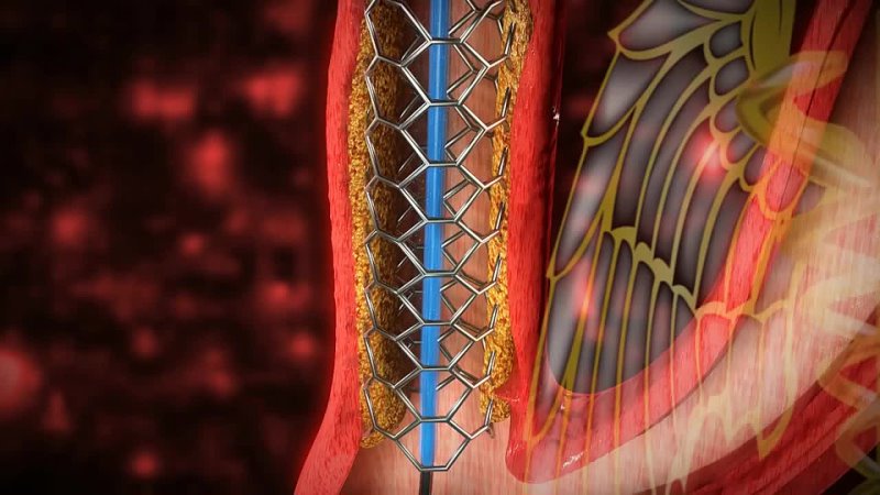 3 D Medical Video ( HD) Carotid Artery