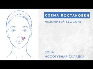 Схема постановки мезонитей на носогубную складку