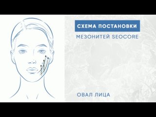 Схема постановки мезонитей Seocore на овал лица