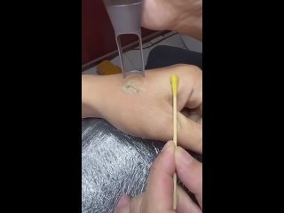 Вот так происходит удаление тату
Это круто (видео)