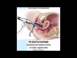 Резектоскопия: субмукозная миома матки и полип эндометрия