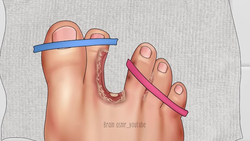 Brain ASMR ASMR Treatment athletes foot and warts between toes at home, Foot care