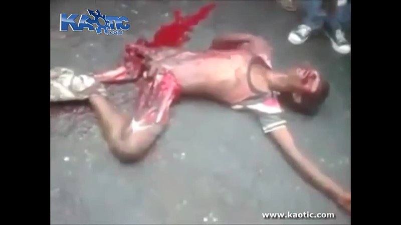 Mans Legs Virtually Ripped Off And Skinned
