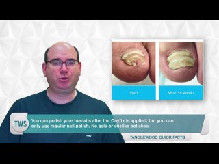 [Dr. Andrew Schneider] How to Treat an Ingrown Toenail Without Surgery