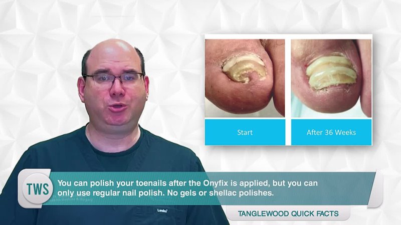 Dr. Andrew Schneider How to Treat an Ingrown Toenail Without