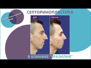 Удаление горбинки носа (септоринопластика) в Калининграде