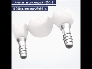 Скидка -65% на импланты зубов в Екатеринбурге!