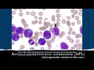 Острый промиелоцитарный лейкоз (гипогранулярный вариант). Мазки периферической крови с доктором Джанетт  Рамос