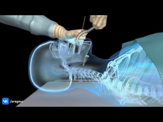 Установка орофарингеального воздуховода -3D анимация