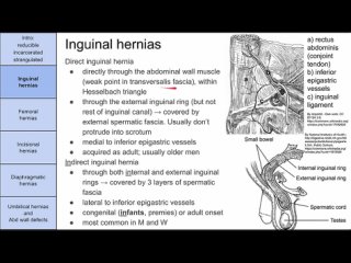 [MedLecturesMadeEasy] Bowel hernias