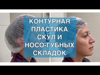 Контурная пластика скул и носо-губных складок в Курске