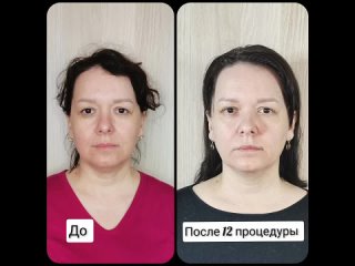 Массаж лица (курс 12раз) эффект Ботакса+лечение проблемной кожи