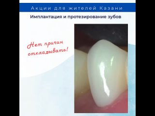 Акции на имплантацию и протезирование зубов в Казани!