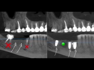 Имплантация зубов Nobel