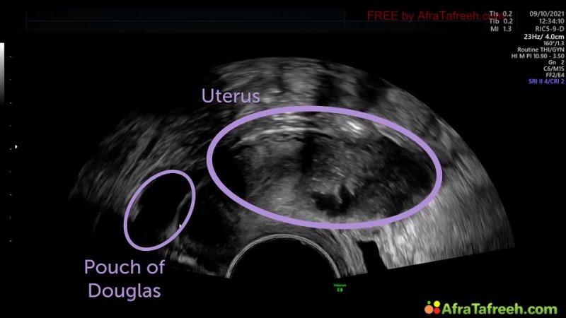 Standard Gynecological US Exam atf