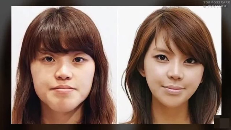Чудо корейские хирурги. Пластическая хирургия до и после