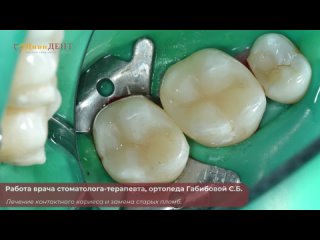 Работа стоматолога-терапевта, ортопеда Габибова - лечение кариеса и замена старых пломб