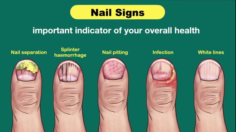 Nail signs of Disease Nail pitting Finger clubbing Signs of anemia Terrys