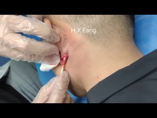 Sebaceous cyst infection-Abscess incision and drainage（皮脂腺囊肿感染脓肿切开排脓）2023-08-27