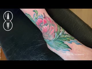 Исправление некачественной татуировки с келоидным рубцом