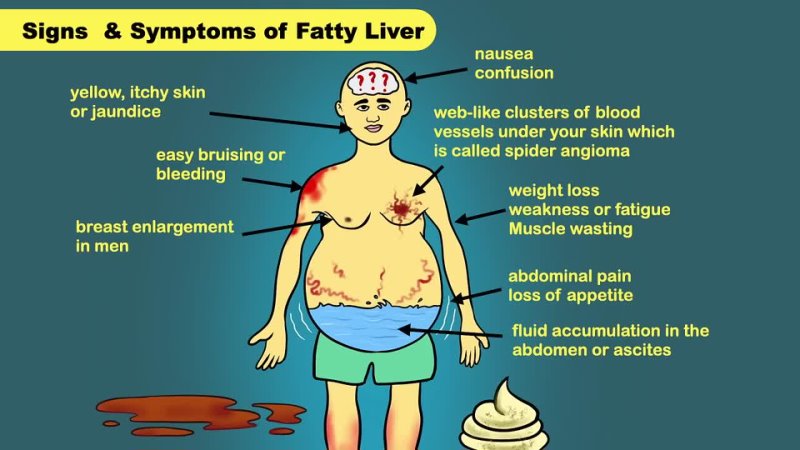 Fatty Liver Treatment Fatty Liver Diet Liver Detox Fatty Liver Fatty Liver
