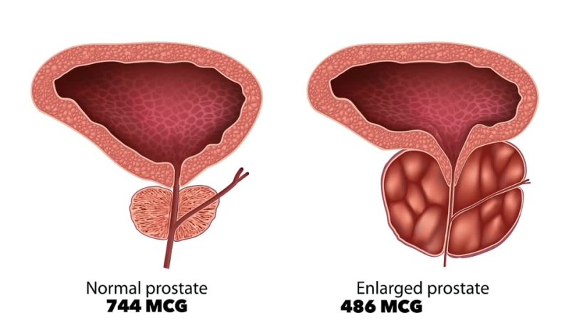 How to Shrink Your Prostate Naturally The, 1 Nutrient You