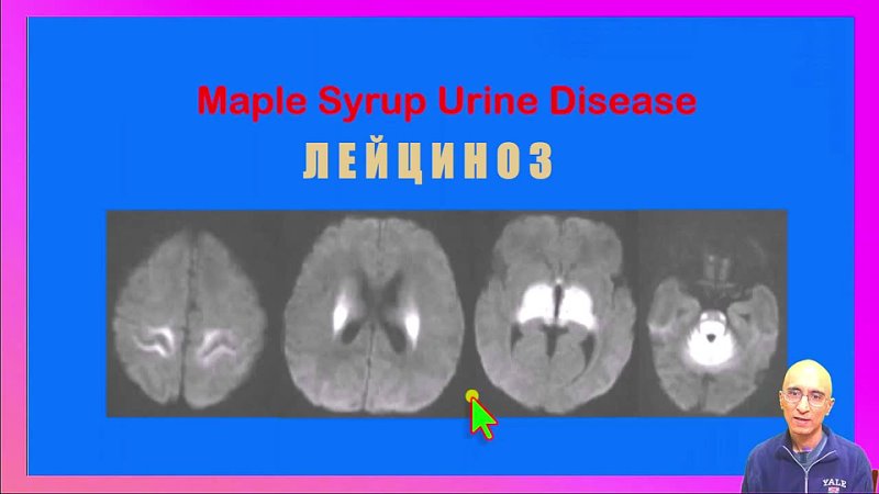 Maple Syrup Urine Disease