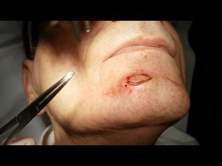 Sebaceous cyst removal with Laser
