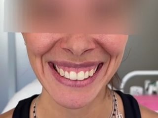 Коррекция десневой улыбки (до процедуры)
