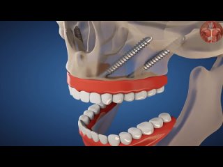 3D анимация имплантации.mp4