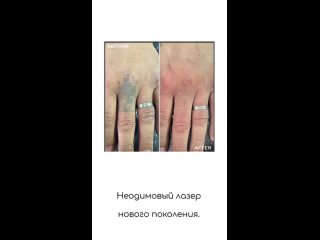 Video by Перманентный макияж|Удаление тату| Зеленогорск