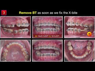 Bite Turbos：General concepts and Clinical application. Chris Chang Ortho