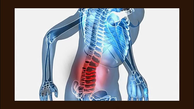 Радикулит поясница. Пояснично-крестцовый радикулит. Люмбаго. Опорно-двигательный аппарат человека. Дискогенный радикулит.