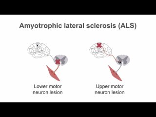 Clinical Neurology Essentials  peripheral neuropathy