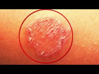 How to Deal With Ringworm Naturally