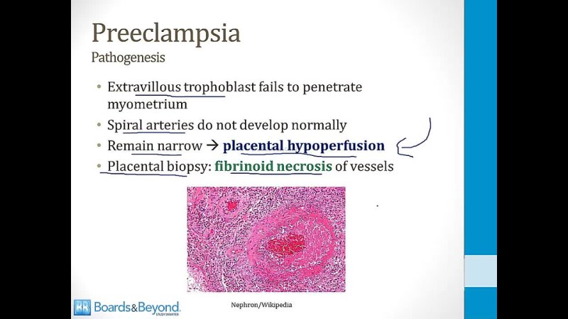 Reproductive - 2. Pregnancy - 6.Hypertension in Pregnancy atf