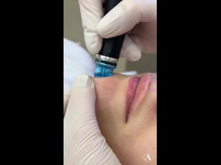 Глубокое очищение кожи на аппарате HydraFacial в клинике “Анатомия Privilege“