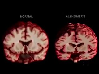 Мозг здорового человека и страдающего болезнью Альцгеймера.