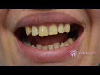 Имплантация зубов в Уфе